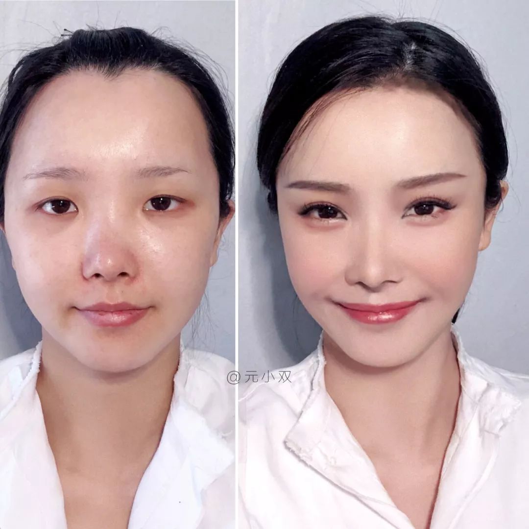 为什么三庭五眼眼距宽,眼距宽怎么改善做什么手术