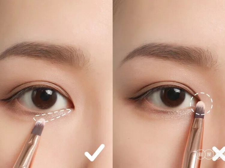 为什么三庭五眼眼距宽,眼距宽怎么改善做什么手术