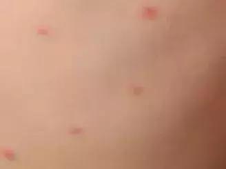 宝宝身上一大片的包是怎么回事,宝宝身上好多片包