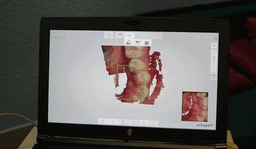 儿童换新牙长歪了怎么办,一不小心把牙给弄断了怎么办