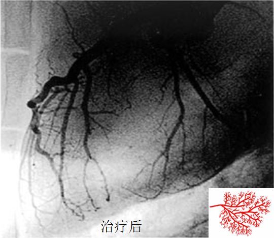 体外心脏震波治疗费用,北京医院介入治疗微创中心