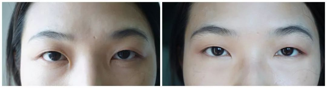 30岁眼角笑起来有皱纹,眼角笑起来有皱纹是老了吗