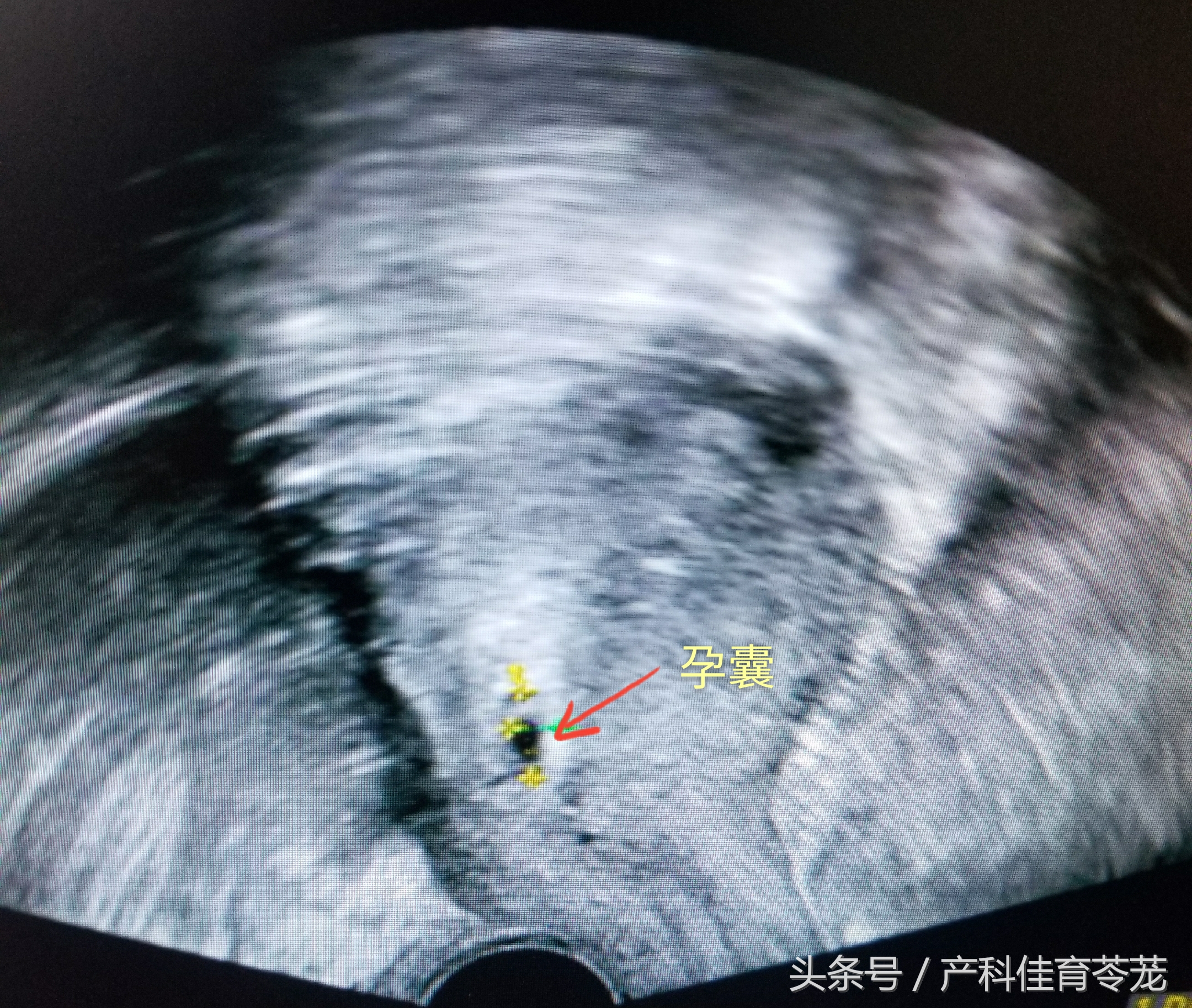 剖宫产横向瘢痕妊娠概率,怀孕7周异位妊娠瘢痕子宫