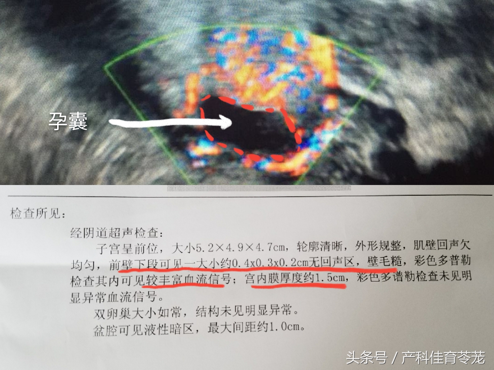 剖宫产横向瘢痕妊娠概率,怀孕7周异位妊娠瘢痕子宫