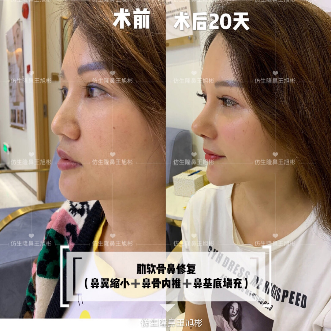 缩鼻翼可以改善鼻翼下垂吗,鼻翼肥大之鼻翼缩小术你见过吗