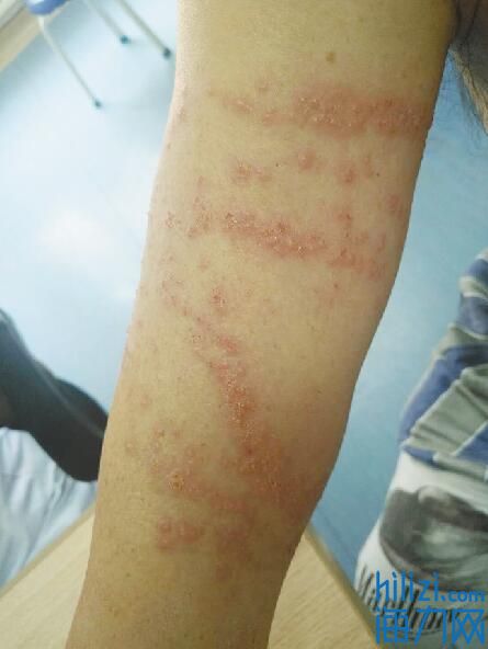 男子被蜇伤用艾蒿水洗致水疱和渗出