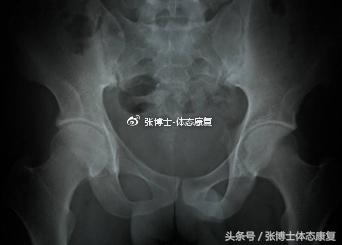 强直性脊柱炎髋关节粘连康复训练,运动疗法强直性脊柱炎研究现状