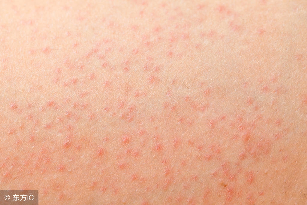 皮肤毛囊炎症状及治疗方法,胸口毛囊炎发红发痒