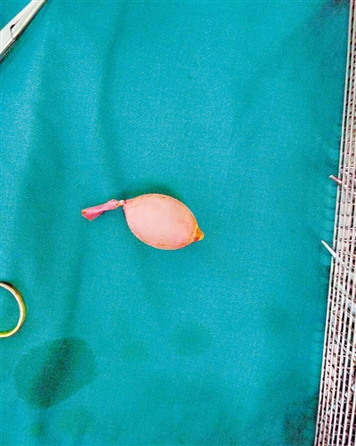 8岁男孩竟把气球吞进肚里，气球还装了水……