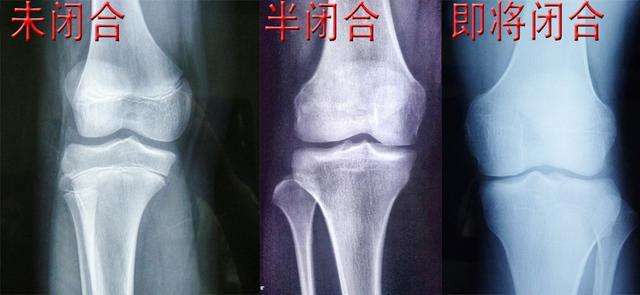 骨骺提前闭合真的不能长高吗,青春期孩子骨骺闭合如何长高