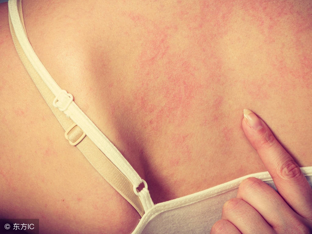 得了湿疹怎么办最快最有效,婴儿干性湿疹的原因及治疗方法