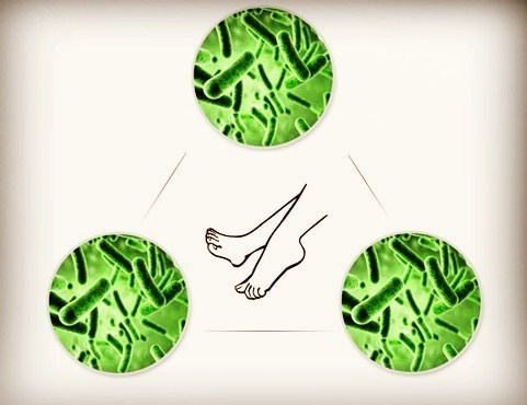 增厚型脚气治不好,脚气真的治不好吗