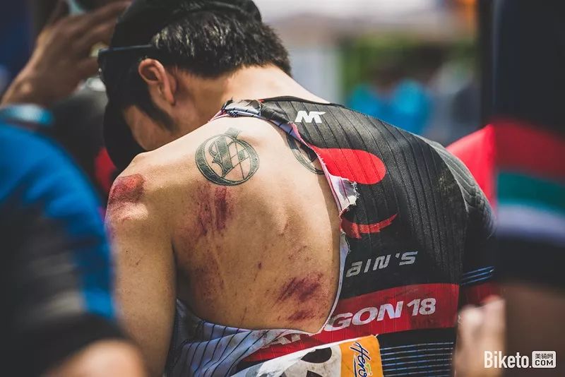 摔车下巴擦伤的正确处理方法,摔车伤口留疤怎么办