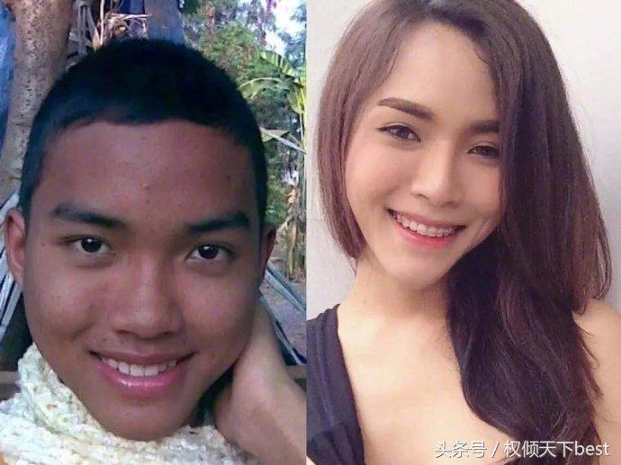 泰国人变性术前后对比,泰国的变性手术是什么原理