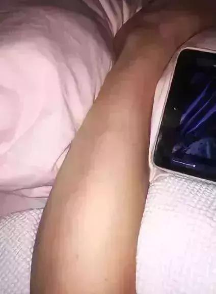 女孩脑袋上有个寄生虫,25岁女孩身体发现寄生虫