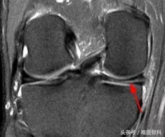nba半月板损伤都是怎么恢复的,nba球星半月板损伤恢复比较好的