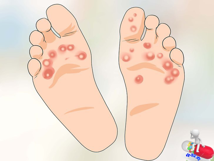 还在为脚臭而发愁吗,这些秘方帮您攻克顽固脚气