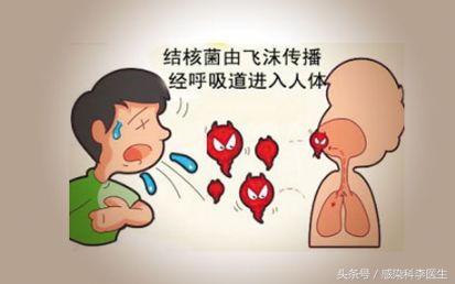 得了肺结核怎么调理好得快,得了肺结核医院怎么处理