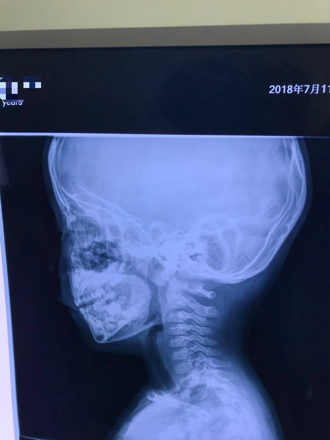 刘鉴医案：刘医生，我女儿的腺样体好了