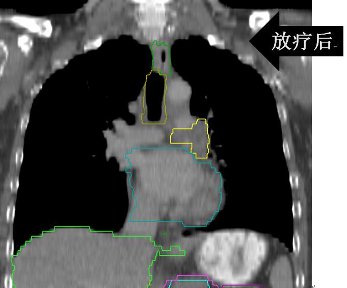 安罗替尼治小细胞肺癌吗,卡瑞利珠能治小细胞肺癌吗