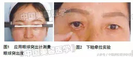 外眦悬吊固定视频操作方法,眼睑松弛矫正手术术前设计方案