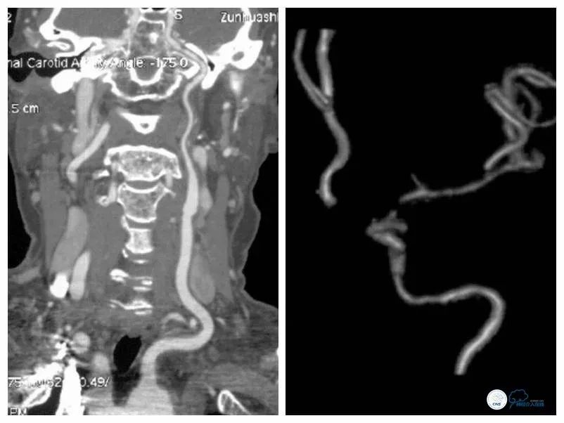 天坛医院住院日记,颈内动脉c5到c7段狭窄微创手术