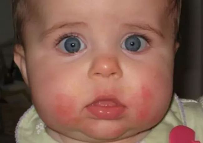 儿科医生：宝宝为什么流口水？宝宝流口水的5大原因及解决措施！