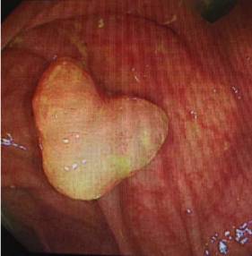 当内镜遇到情人节……