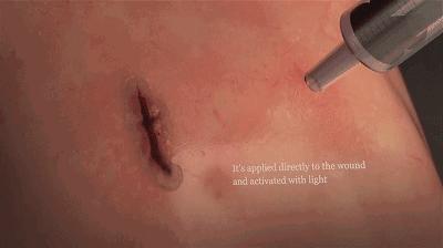 伤口愈合擦什么药膏不会留疤,伤口怎么正确处理不留疤