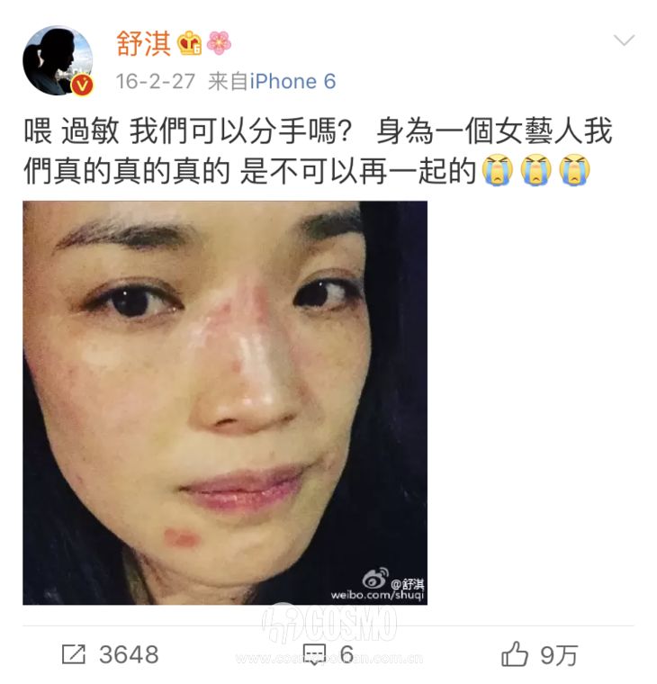 舒淇皮肤过敏,舒淇过敏脸是怎么好的