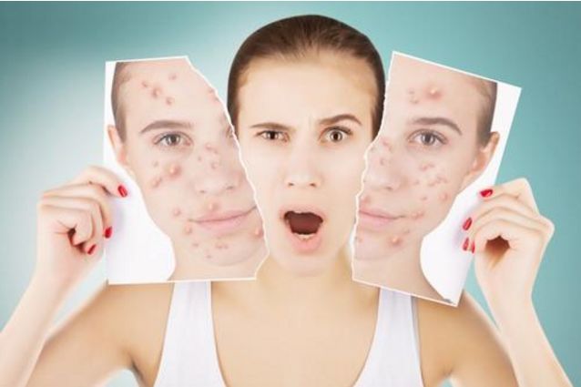 青春痘疤痕消除的药膏,青春痘疤痕图