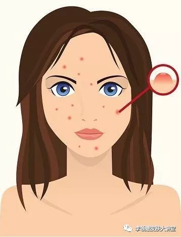 杏林微科普痔疮能自愈吗,治粉刺视频杏林讲堂