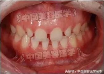 牙齿缝隙发黑怎么清洁,牙齿根部窄缝隙大怎么修补