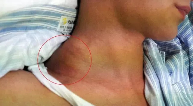 胎记也能要人命！20岁帅小伙“蝇子屎”胎记疯长鸡蛋大小，危在旦夕