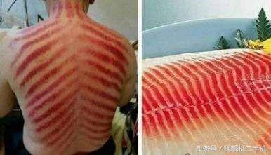 刮完痧第二天排便轻松,后背刮完痧特别轻松