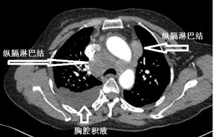 胸水为什么会抽不到,胸水抽了为什么还呼吸困难