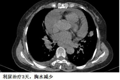 胸水为什么会抽不到,胸水抽了为什么还呼吸困难