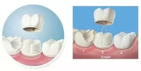 市面上冷光美牙仪真的有用吗,冷光美牙仪对牙齿伤害有多大