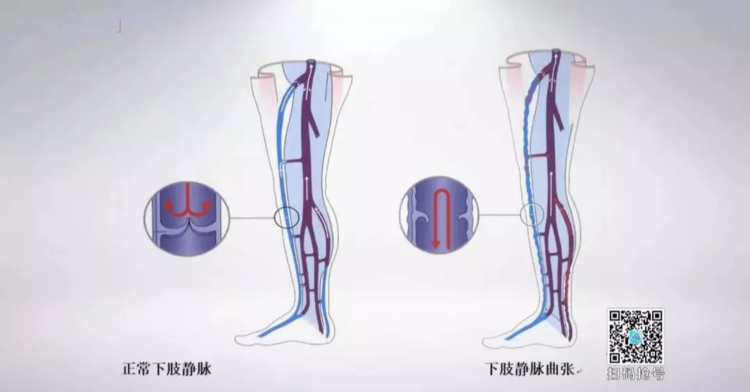 腿部网状静脉曲张的最快消除方法,怎样治静脉曲张和蚯蚓腿