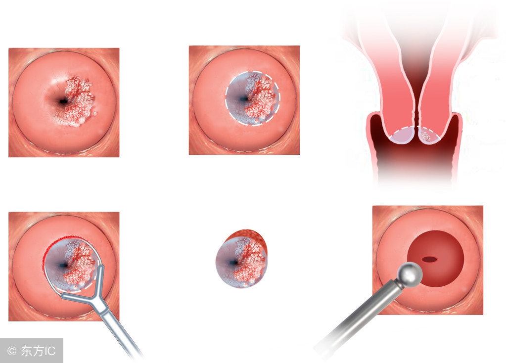 宫颈糜烂是不是妇科病最严重的,怎么预防宫颈糜烂和妇科病