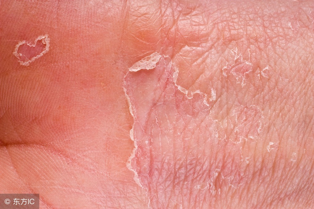 湿疹脱皮是怎么回事,湿疹脱皮结痂用什么药