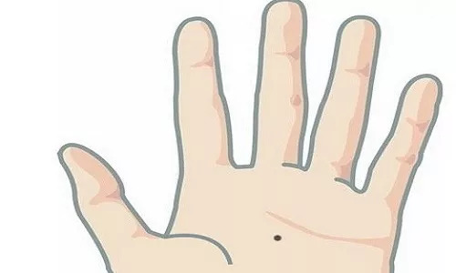 色素痣激光去除后需要贴疤痕贴吗,电离子和激光去除色素痣哪个好