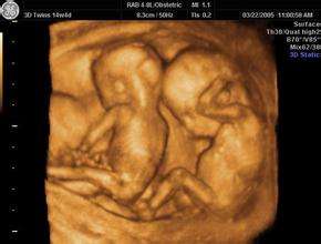 孕妇产检多次B超均为双胞胎,剖腹产后只有一胎:孩子去哪了?