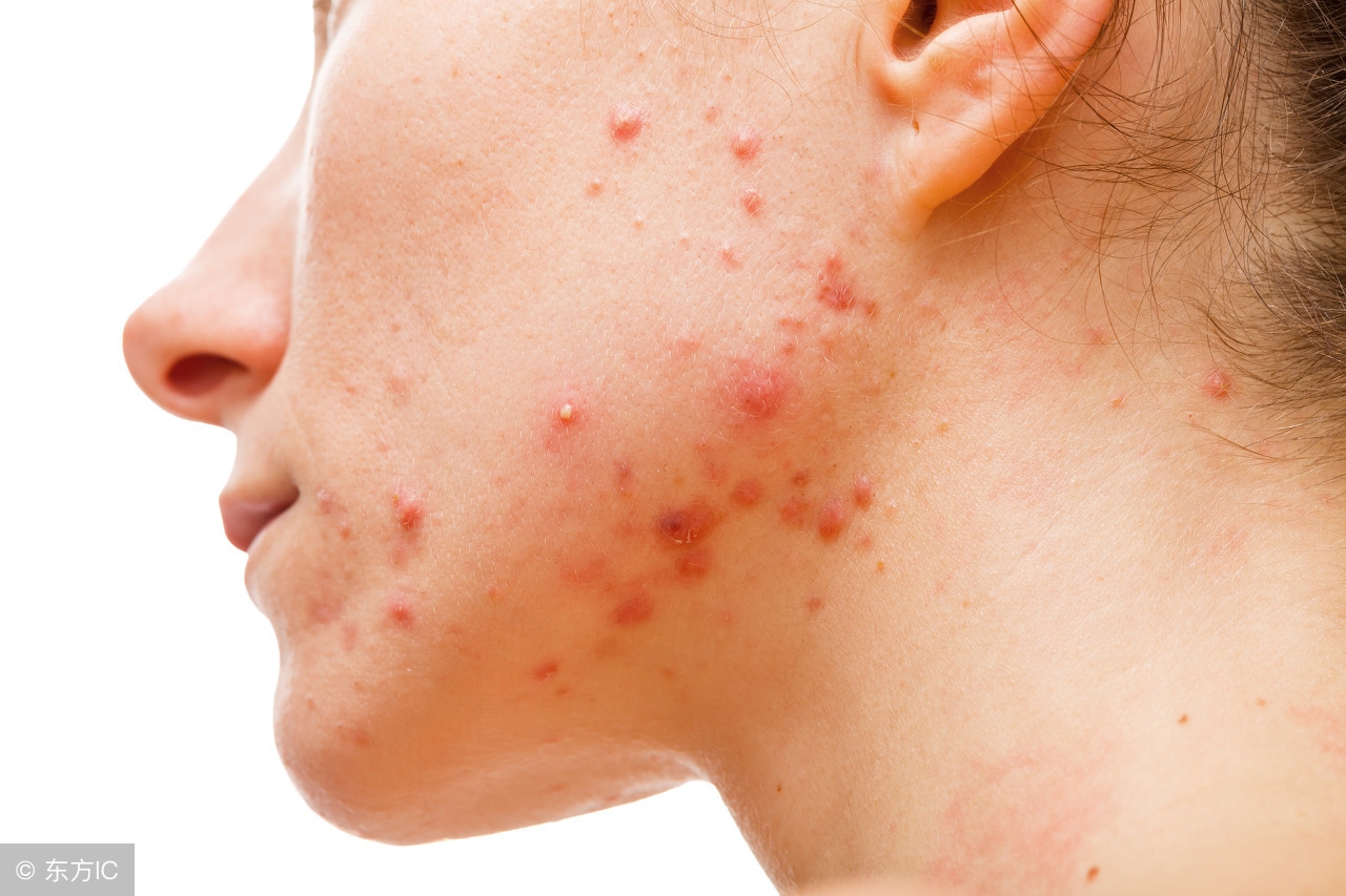 脸上都是痘印了还用吃异维a酸吗,没长痘了需要继续吃异维a酸吗