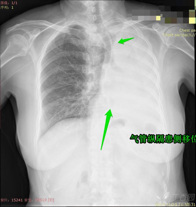 又见白肺，一文教你如何跟患者讲解平片，收藏！