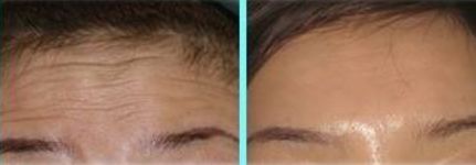 抬头纹特别深是怎么回事,有抬头纹太严重是什么原因导致的