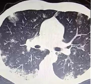 每日咳嗽是什么原因,每日咳痰