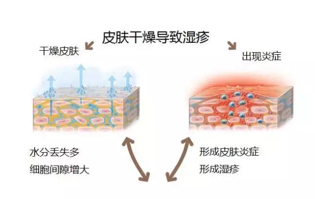 宝宝湿疹康复的全过程,宝宝湿疹不严重也不见好