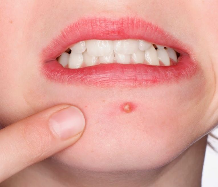 闭口粉刺最快的解决方法,闭口粉刺怎么去除不留疤痕