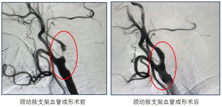 颈动脉脑血栓,颈动脉堵塞造成脑梗怎么预防
